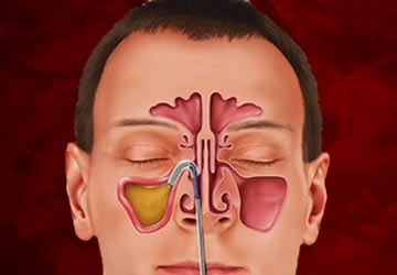 Sinusitis